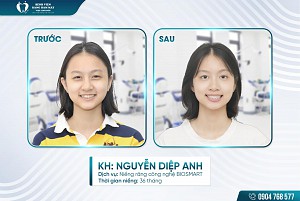 Khách hàng Nguyễn Diệp Anh niềng răng BIOSMART
