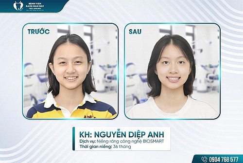 tu-ngai-cuoi-den-tu-tin-toa-sang-nho-nieng-rang-biosmart thumbnail