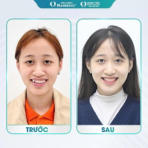 Niềng răng mắc cài 3M (Mỹ) chính hãng – Ưu đãi trọn gói chỉ từ 23,9 triệu, cam kết không phát sinh