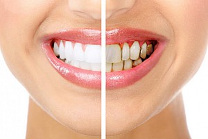 Những hậu quả bọc răng sứ giá rẻ gây ra mà bạn không ngờ tới