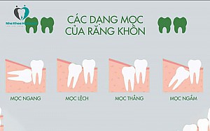 Nhổ răng khôn an toàn, không đau tại Hoài Đức, Hà Nội