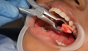 Nhổ răng khôn an toàn, không đau tại Hoài Đức, Hà Nội