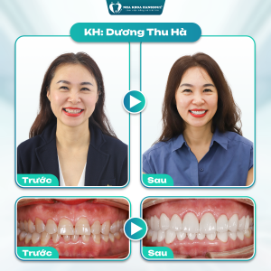 Khách hàng Dương Thu Hà bọc sứ