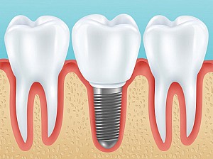 Hanseoul Mon Bay – nơi trồng răng Implant uy tín tại Hạ Long Quảng Ninh
