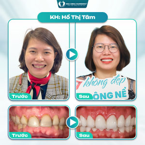 Khách hàng Hồ Thị Tâm thay đổi ngoạn mục sau bọc sứ