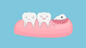 Lưu ý sau khi nhổ răng khôn và cách chăm sóc răng miệng