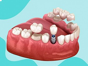 Hanseoul Mon Bay – nơi trồng răng Implant uy tín tại Hạ Long Quảng Ninh