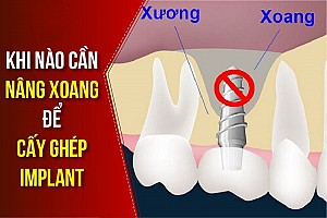 Hanseoul Mon Bay – nơi trồng răng Implant uy tín tại Hạ Long Quảng Ninh