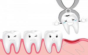 Nhổ răng khôn an toàn, không đau tại Hoài Đức, Hà Nội