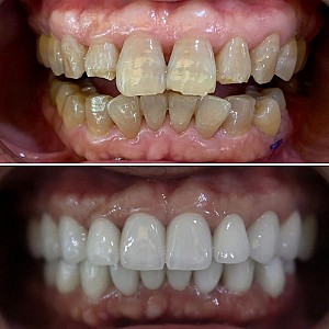 Giá bọc răng sứ sau khi lấy tủy là bao nhiêu tiền? Những điều cần biết về bọc răng sứ sau khi lấy tủy