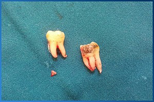 Nhổ răng khôn an toàn, không đau tại Hoài Đức, Hà Nội