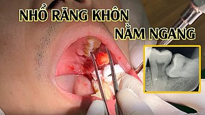 Nhổ răng khôn an toàn, không đau tại Hoài Đức, Hà Nội