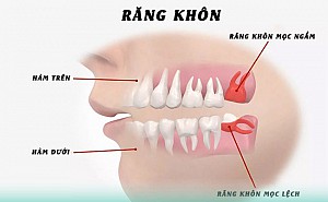 Nhổ răng khôn an toàn, không đau tại Hoài Đức, Hà Nội