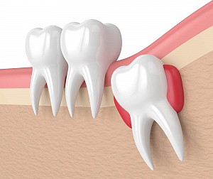 Nhổ răng khôn an toàn, không đau tại Hoài Đức, Hà Nội