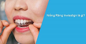 Niềng răng uy tín tại Quận 2 an toàn, chuẩn y khoa