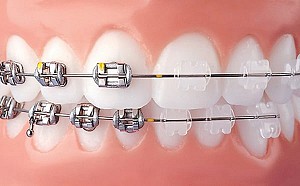 Niềng răng uy tín tại Quận 2 an toàn, chuẩn y khoa