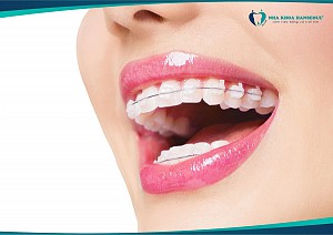 Niềng răng uy tín tại Quận 2 an toàn, chuẩn y khoa