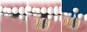 Hanseoul Mon Bay – nơi trồng răng Implant uy tín tại Hạ Long Quảng Ninh