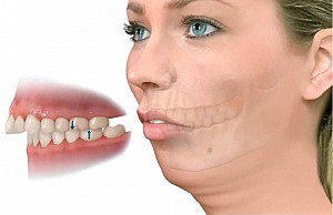 Niềng răng uy tín tại Quận 2 an toàn, chuẩn y khoa