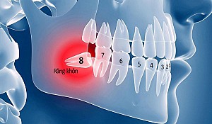 Nhổ răng khôn an toàn, không đau tại Hoài Đức, Hà Nội