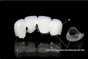 Răng sứ kim loại – Giải pháp trồng răng chi phí rẻ
