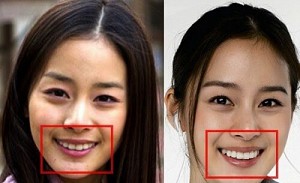 Bọc răng sứ bao nhiêu tiền? Bảng giá tốt nhất trên thị trường năm 2022