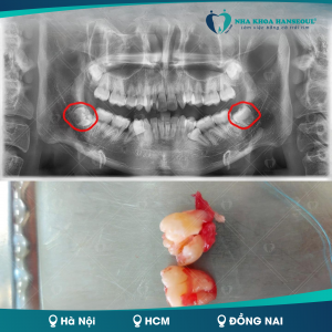 Có nên nhổ răng số 8 khi đang niềng răng?