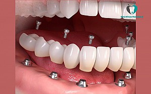 Hanseoul Mon Bay – nơi trồng răng Implant uy tín tại Hạ Long Quảng Ninh