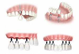 Hanseoul Mon Bay – nơi trồng răng Implant uy tín tại Hạ Long Quảng Ninh