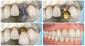 Hanseoul Mon Bay – nơi trồng răng Implant uy tín tại Hạ Long Quảng Ninh