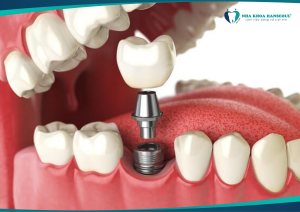 Ai nên trồng răng implant? 4 trường hợp phù hợp + lưu ý quan trọng