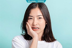 Niềng răng cho trẻ em: Top 3 sai lầm nhiều phụ huynh mắc phải