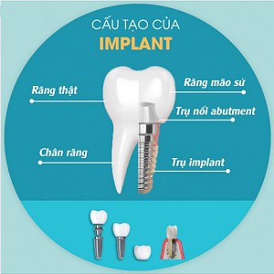 Hanseoul Mon Bay – nơi trồng răng Implant uy tín tại Hạ Long Quảng Ninh
