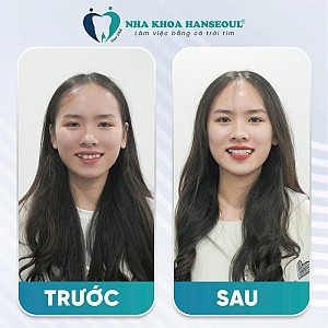 Chị Nguyễn Thùy Hương tìm lại sự thoải mái sau nhiều năm khổ sở vì răng hỏng