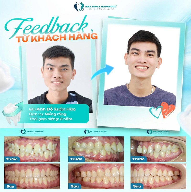 Hành trình lột xác nụ cười sau khi niềng răng của KH Đỗ Xuân Hào