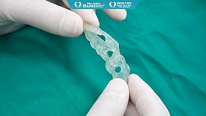 Quy trình trồng răng Implant tại Nha khoa Hanseoul - Bệnh viện RHM Việt Anh Đức chuẩn xác, an toàn với công nghệ hiện đại