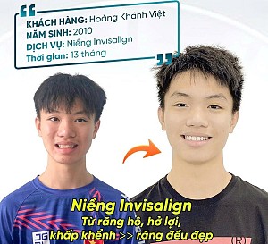 Không còn hô và hở lợi – Hành trình 13 tháng niềng Invisalign của Khánh Việt