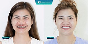 Phục hồi toàn diện vùng răng cửa + răng hàm bằng Implant và răng sứ Lava cao cấp