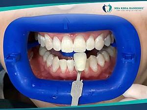 Phục hồi toàn diện vùng răng cửa + răng hàm bằng Implant và răng sứ Lava cao cấp