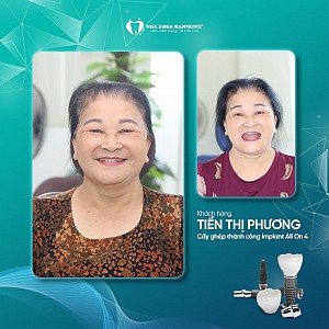 Khách hàng Tiền Thị Giang cấy ghép implant All on 4