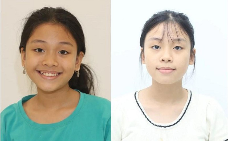 Niềng răng ở “độ tuổi vàng”: Lợi thế giúp bé Uyến Nhi thay đổi sớm