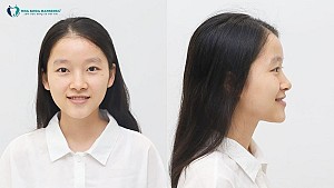 Tự tin mỉm cười sau 15 tháng niềng răng - Hành trình thay đổi của Thu Duyên, 21 tuổi