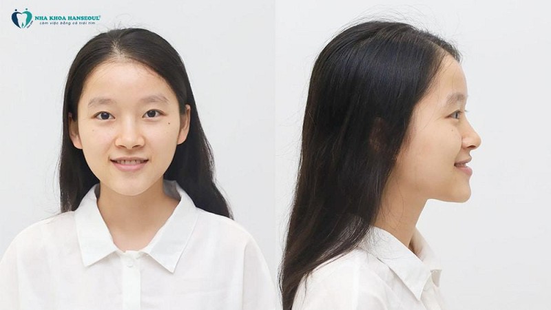 Tự tin mỉm cười sau 15 tháng niềng răng - Hành trình thay đổi của Thu Duyên, 21 tuổi