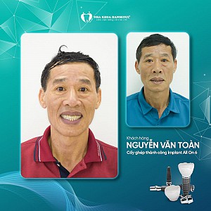 Khách hàng Nguyễn Văn Toàn cấy ghép implant All on 6