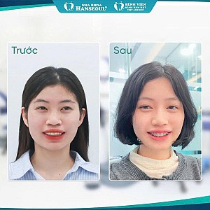 Nguyễn Huy An: dậy thì thành công nhờ niềng răng 