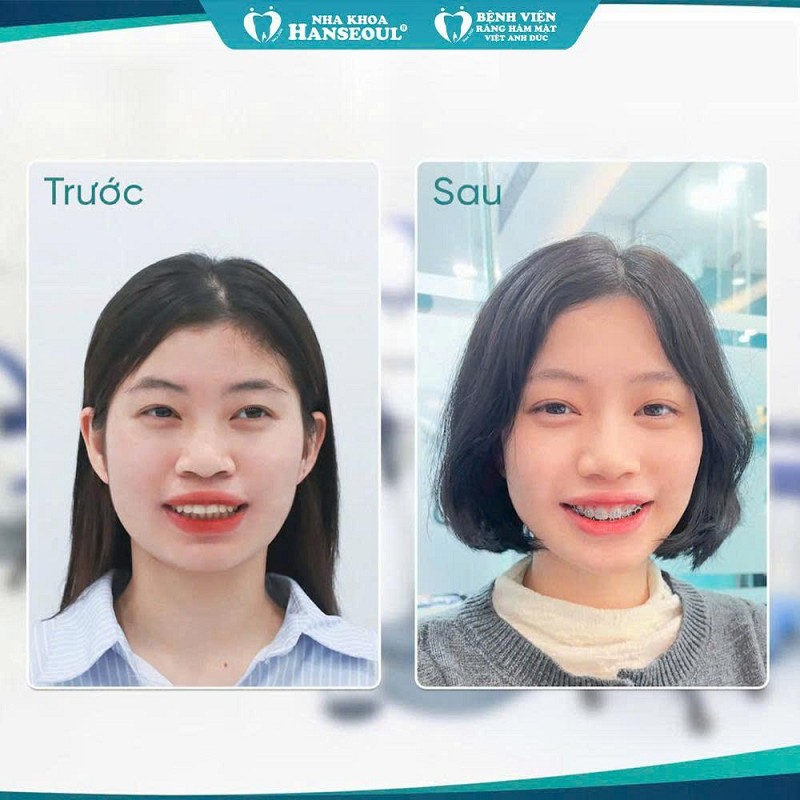 Niềng răng mắc cài 3M (Mỹ) chính hãng – Ưu đãi trọn gói chỉ từ 23,9 triệu, cam kết không phát sinh