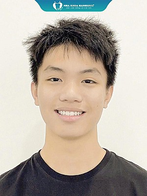 Trương Thị Phượng (2001) và hành trình “lột xác” nụ cười cùng công nghệ BIOSMART tại Hanseoul