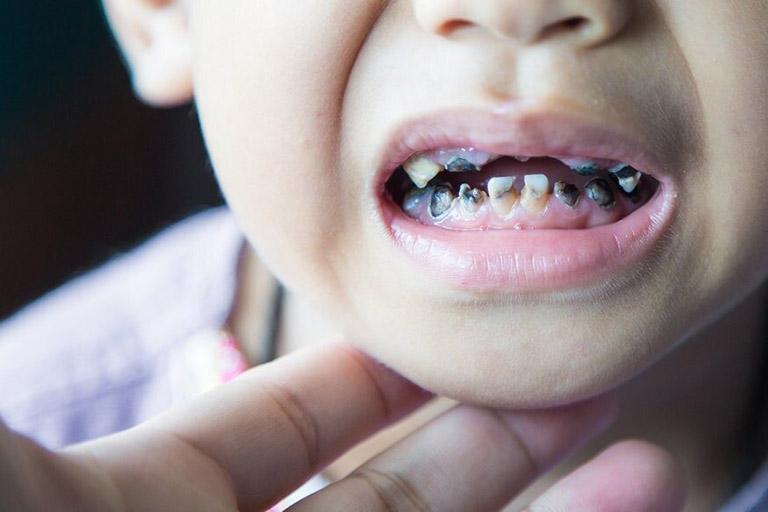 Sâu răng trẻ em đợi thay răng sữa: Những hiểu lầm nghiêm trọng khiến nhiều phụ huynh hối hận