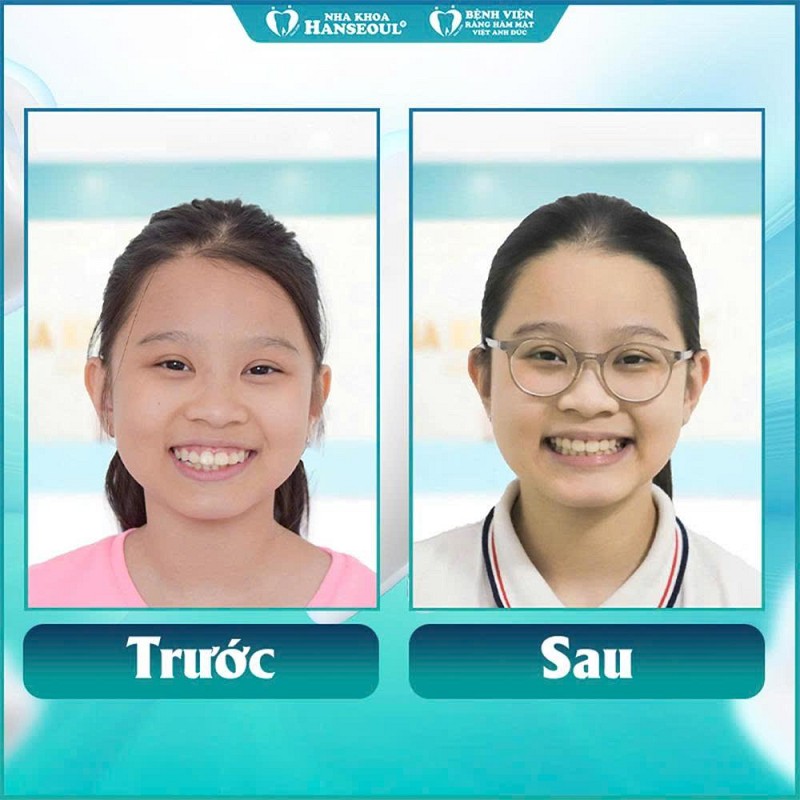 Niềng răng cho trẻ em: Top 3 sai lầm nhiều phụ huynh mắc phải