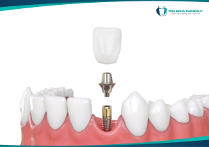 Ưu Điểm Vượt Trội Của Trồng Răng Implant So Với Cầu Răng Và Hàm Giả